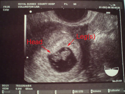 1st ultrasound