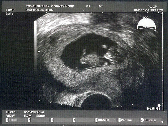 2nd ultrasound