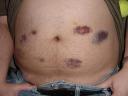 Bruised belly